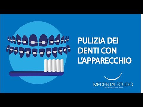 Come pulire i denti con l'apparecchio fisso
