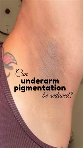 Yes, you heard that right✅ Under Arm Pigmentation can be reduced with The Skin Story’s Under Arm Roll On! 💙Controls Odour 💙Reduces Pigmentation 💙Gently Exfoliates Shop now on www.theskinstory.in or all major e-commerce platforms. #underarpigmentation #darkunderarms #underarmrollon #badodour #trending #viral #explorepage #lacticacid #witchhazel #pentavitin #skincare #bodycare #theskinstory | The Skin Story