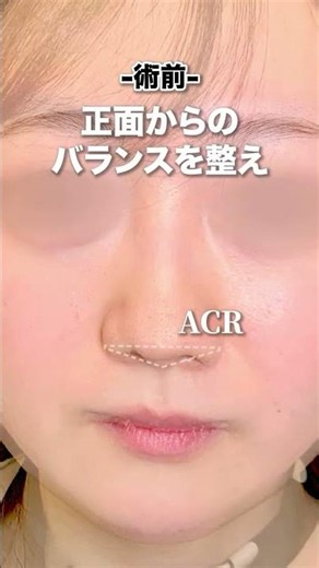 👃✨【鼻柱下降の症例】鼻尖形成と軟骨移植と併用｜鼻を自然に美しく、人中を短く見せたい方におすすめの鼻整形を症例で解説！