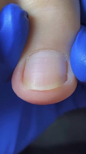 Pedicure #fypシ #fyp #ingrowntoenail #foryou #tiktok #foryoupage