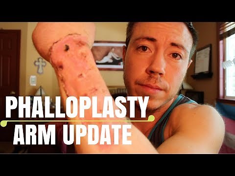 FTM Phalloplasty Arm Update