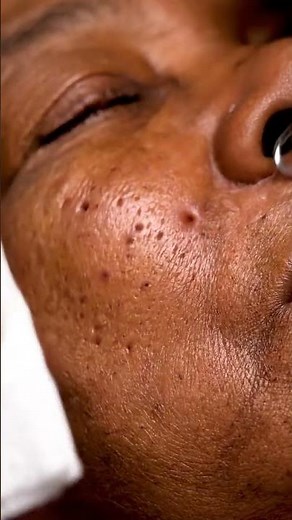 “Deep Blackhead Removal – Super Satisfying Close-Up!”