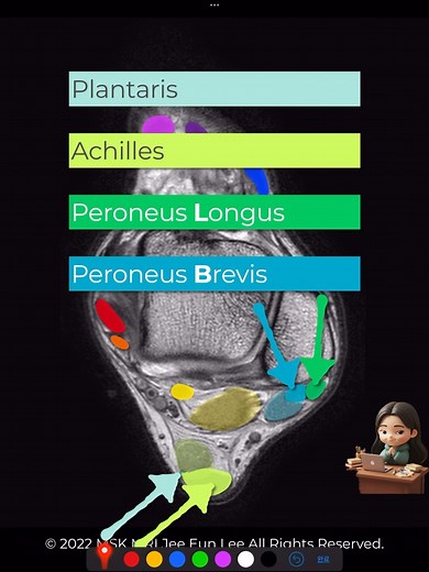 5.3K views · 76 reactions | [Coalition 21] Peroneus Longus, Brevis,...