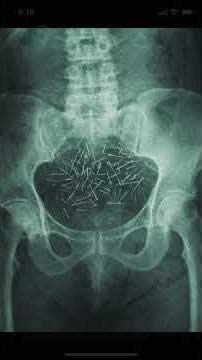 Albert Fish, The Elderly Menace. #horror #truecrimestories