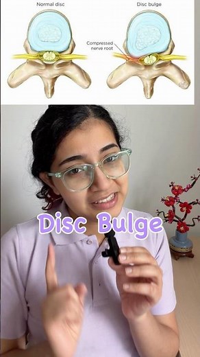 What a Disc Bulge Actually Looks Like
