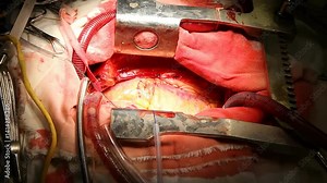 Cardiac surgery. Open heart surgery. Heart transplant from a donor. Open chest, beating heart, surgical instruments.