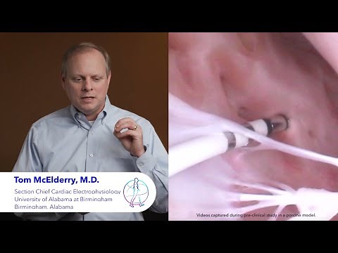 DiamondTemp™ ablation system - The next generation of RF ablation