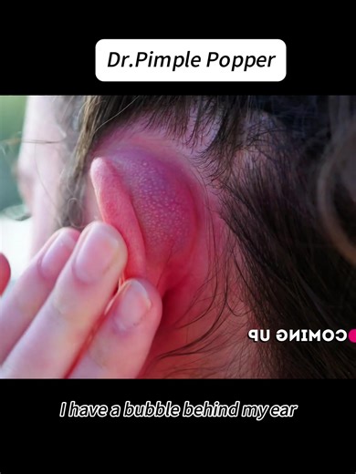 Effective Cyst Removal Techniques by Dr. Pimple Popper