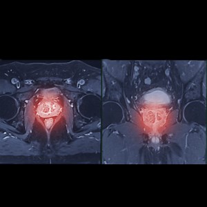 166 reactions · 36 shares | From screening to diagnosis to treatment, our prostate cancer breakthroughs are improving care for men everywhere. Access our free prostate cancer guide to learn more and get answers today. | Cleveland Clinic | Facebook