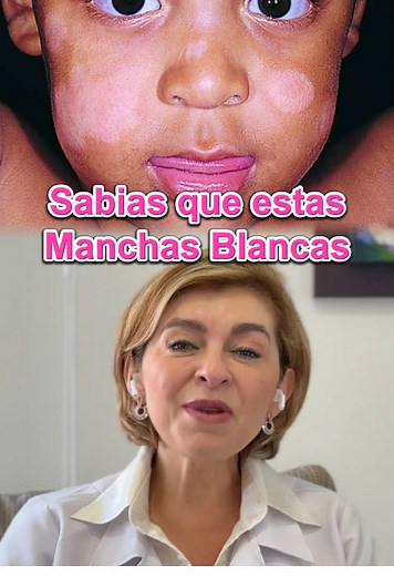 Manchas Blancas en la Piel de Niños: Causas y Cuidados