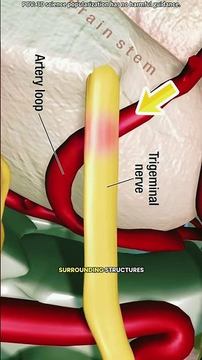 Microvascular decompression surgery (3D animation)