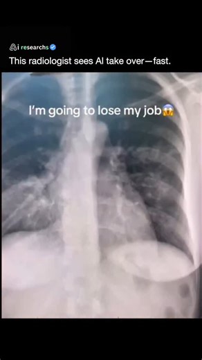 AI researches | AI on Instagram: "A radiologist showing how AI read a chest X-ray—and nailed the diagnosis. The AI’s precision sparked buzz on Reddit, with people debating whether it could outperform human doctors. It accurately spotted conditions like pneumonia, raising real questions about job security. But research from Harvard and reports from The New York Times say AI isn’t replacing radiologists—it’s helping them work faster and smarter. This moment shows how fast AI is moving into healthc
