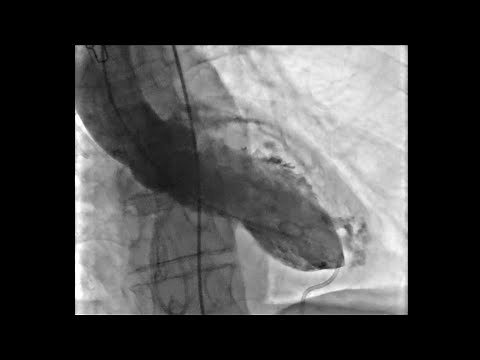 Left Ventricular Anterior Free-Wall Rupture After Subacute Myocardial Infarction