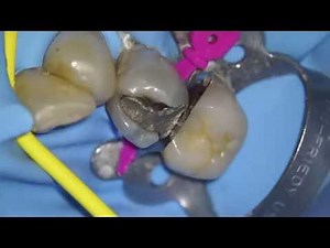 28 amalgam removal direct vision at Towson Dentist