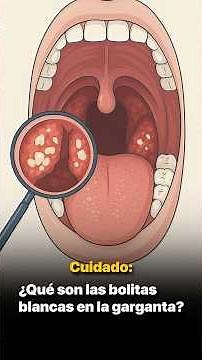 Caution: What are the white bumps in the throat?