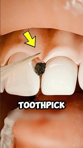 The Hidden Danger of Toothpicks 😱🦷 Dentists Warn About This!
