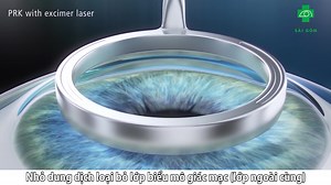 1.5K views · 25 reactions | PHƯƠNG PHÁP XÓA CẬN PRK ⚡ PRK...