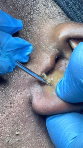 Extraction of pimples from the ear. #asmr #blackheadremoval #satisfying #extraction