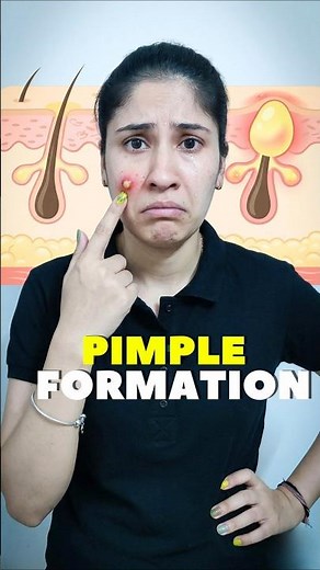 How Pimples Form?