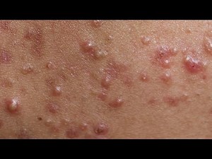 Daily Video Relaxing with Sophia Skin Care, Acne, Whiteheads & Blackheads #02