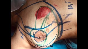 Oncoplastic Breast Surgery