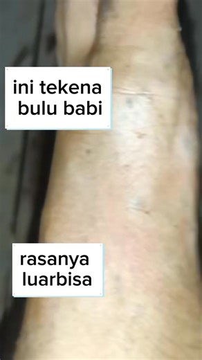 😱 You won't believe what came out of this one... #pimplepop #satisfying | Blackhead Top