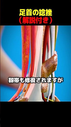 足首の捻挫（解説付き）
