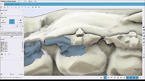 آموزش MAESTRO 3D (ارتودنسی دیجیتال) قسمت چهارم _Brackets Removal