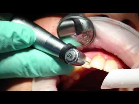 Solea Laser Cavity Removal