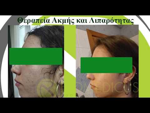 Ακμή Προσώπου. Θεραπεία, Αίτια και Συμπτώματα. (Επεισόδιο 46)