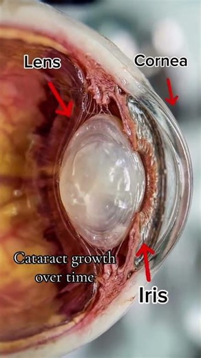 Cataract formation over time
