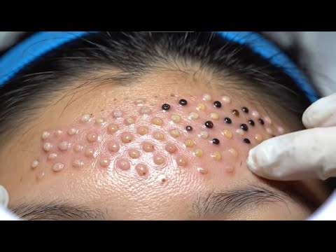 Deep Skin Cleansing Therapy Extreme Acne & Balch