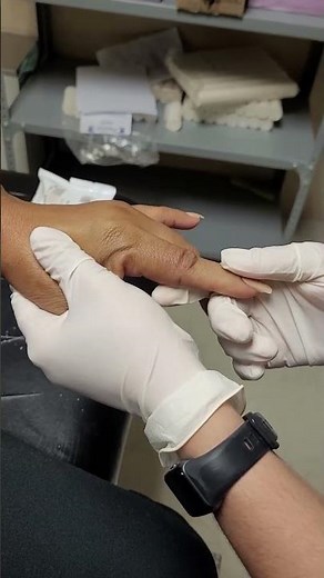 Index finger dislocation