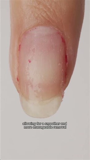 Patented Butterfly Removal Technology | SHELLAC