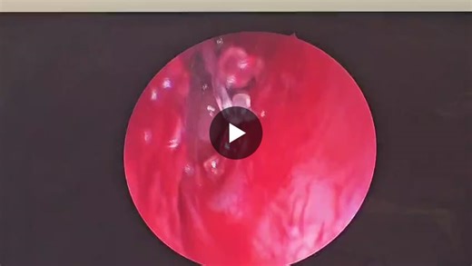 Advancement is Functional Endoscopic Sinusez Surgery Frontal sinus surgery with PROPEL Stent | Dr.Menwal Harb