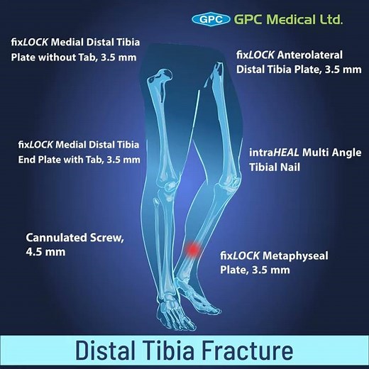 Distal Tibia Fractures | Orthopedic Trauma Portfolio | GPC Medical Ltd.