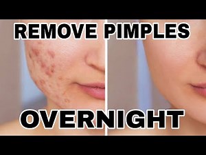 How to Remove Pimples Overnight /Acne Treatment/Natural Health Care and Beauty Tips