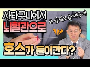 '뇌혈관 조영술' 이렇게 하는 겁니다 - 신경외과 신사부 #26