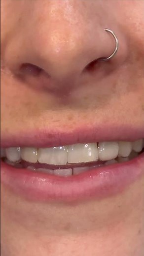 Invisalign with a Pontic in place for missing lateral incisor. #invisalign #orthodontics