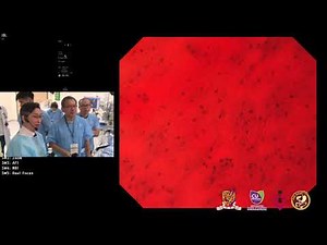 Case 2_Diagnostic OGD, endocytoscopy and endoscopic submucosal dissection of esophageal melanoma