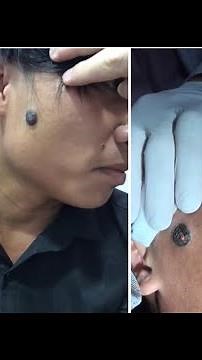 Tẩy Nốt Ruồi Khủng Nhất Vịnh Bắc Bộ Bằng Laser Trong 1 Nốt Nhạc ❌❌❌