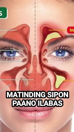 Lunas Herbal Capsule: Solusyon sa Sipon at Sinusitis