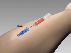 Introcan Safety® IV Catheter