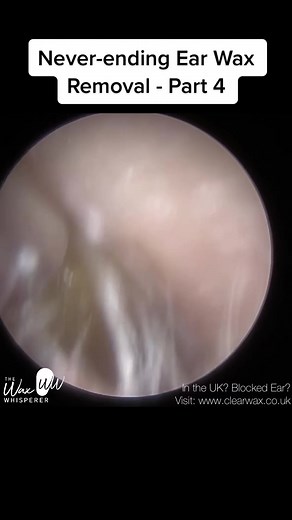 #ear #earwax #earwaxremoval #earwaxcleaning #earwaximpaction #audiologist #thewaxwhisperer