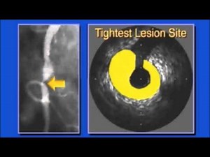 IVUS animation