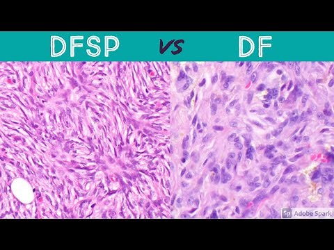 DFSP vs DF (dermatofibrosarcoma protuberans vs dermatofibroma): pathology dermatology dermpath