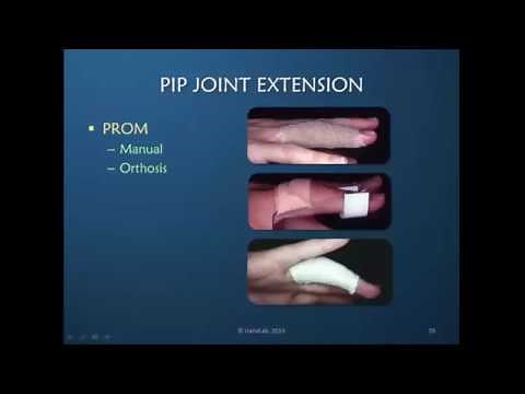Obstinate PIP Joint: Part 6 of 12: Regaining PIP Joint Extension
