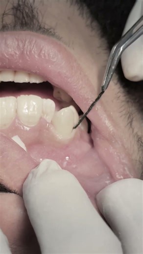 Composite veneer for anterior canine tooth after removal of class V caries #dentist
