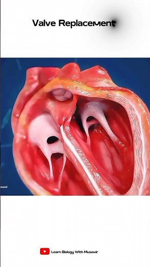 Heart Valve Replacement | Short animation