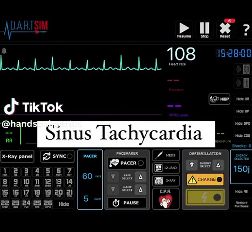 Ventricular Tachycardia is one of the most dangerous Tachyarrhythmia. If the patient is unstable, synchronized Cardioversion must be given. #synccardioversion #syncronizedcardioversion #acls #ecg #arrhythmia #cardiacarrhythmia #ventriculartachycardia #handsonheart #nurselife #nursenyc #ahaacls